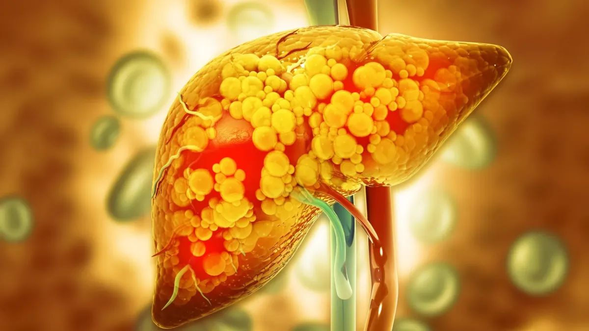 Enzyme Discovery Offers Hope Against Worsening Fatty Liver Disease